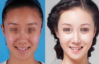 熱拉提的治療效果好不好？多久起效？